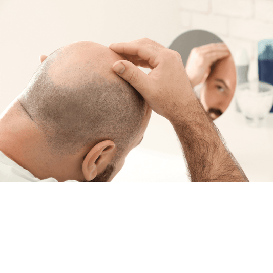 All About Hair Transplants