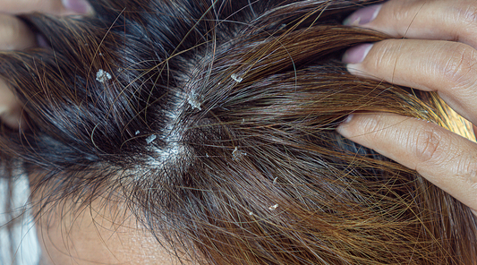 Dandruff | Natural remedies to get rid of dandruff