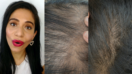How can we reduce DHT on the scalp?