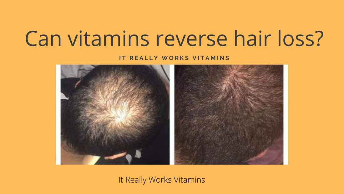 Can vitamins reverse hair loss