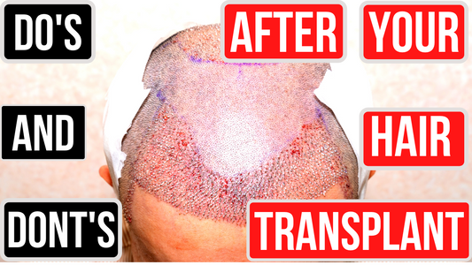 Can I use a derma roller after my hair transplant?