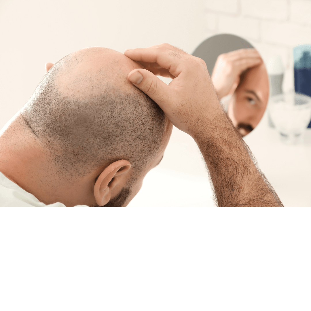All About Hair Transplants