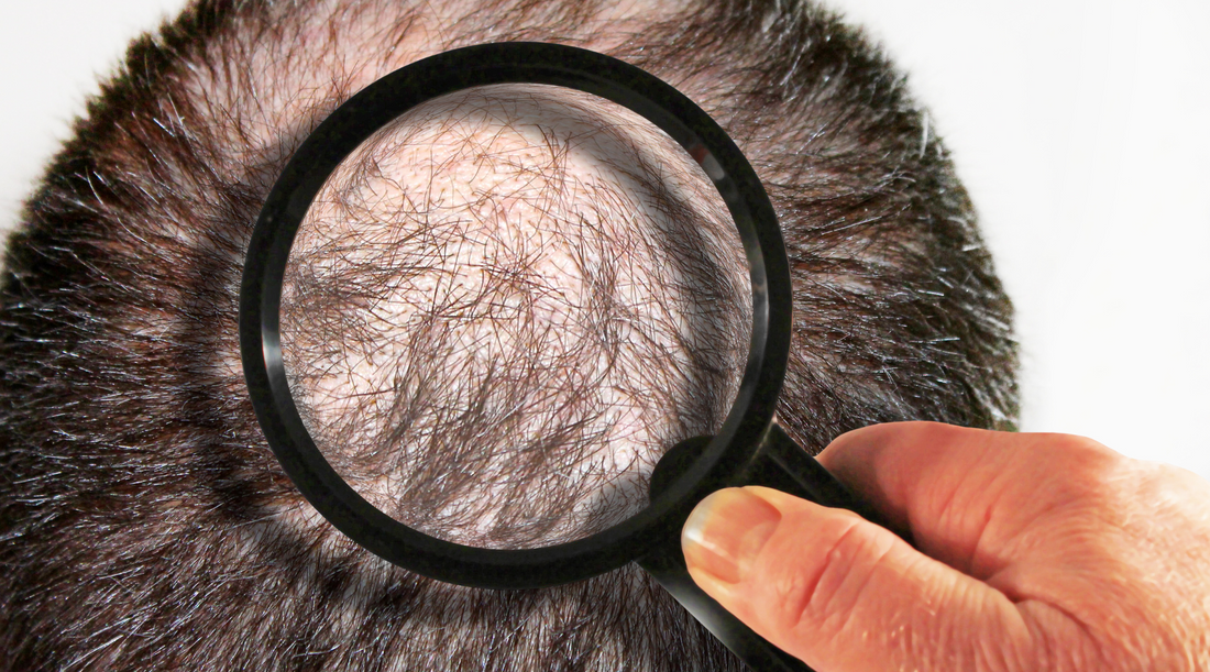 How Does Smoking Affect Hair Loss?