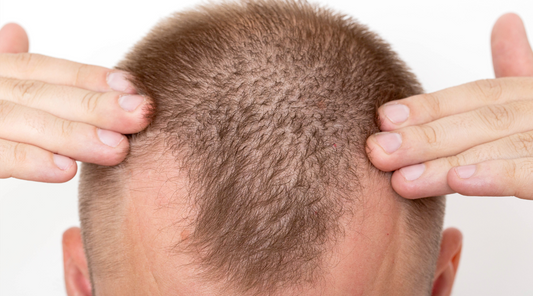 Can you remove DHT from the scalp?-It Really Works Vitamins