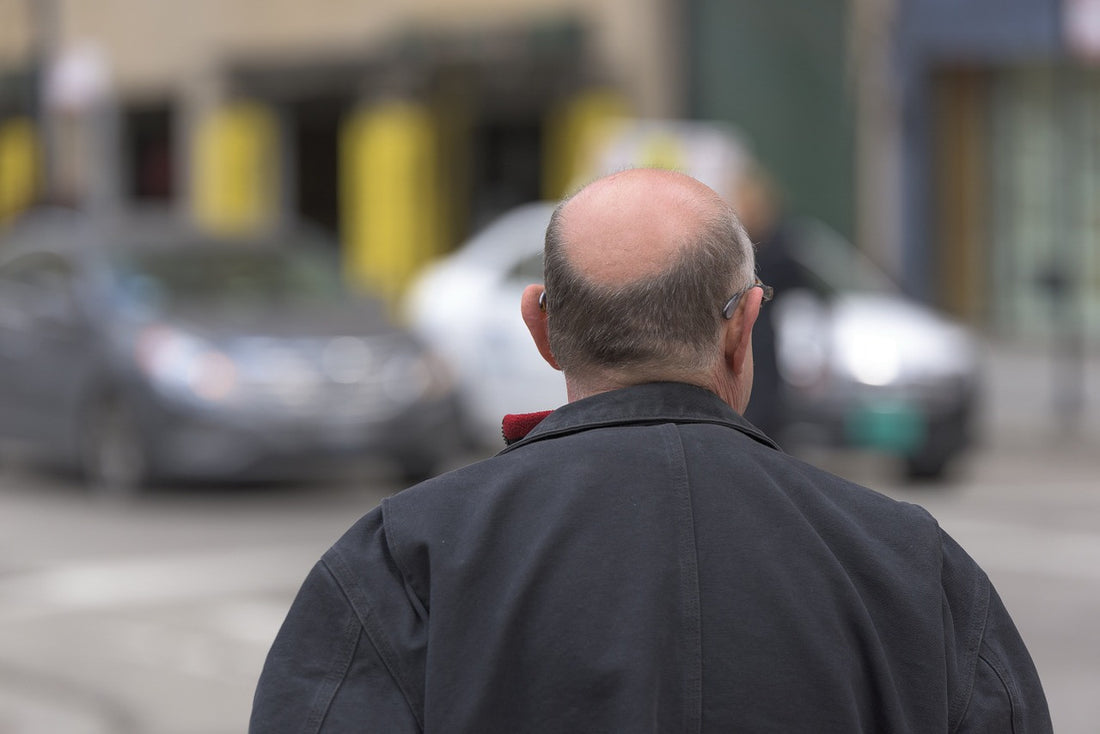 5 Affordable Hair Transplant Alternatives for Dealing with Hair Loss