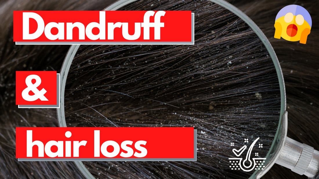 Can dandruff cause hair loss?