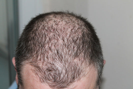 How to get Thicker Hair, Male Hair Loss, It Really Works Vitamins